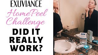 Do At Home Peels REALLY Work My Exuviance Peel Results [upl. by Nylhtak]