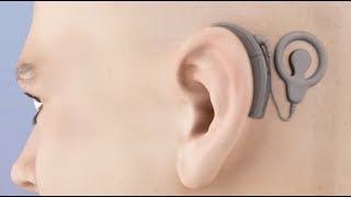 Cochlear Implant Animation [upl. by Eetnom]