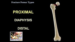 Fracture Femur Antegrade Rodding  Everything You Need To Know  Dr Nabil Ebraheim [upl. by Bannister23]