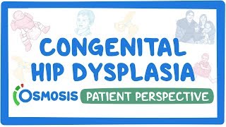 Fibrous Dysplasia  Everything You Need To Know  Dr Nabil Ebraheim [upl. by Ahcsropal]