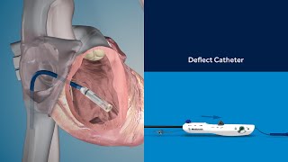 Micra TPS Implant Procedure Animation [upl. by Moonier]