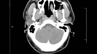 Introduction to the CT Brain [upl. by Balmuth]