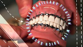 Intermaxillary Fixation with Erich Arch Bars [upl. by Resarf]