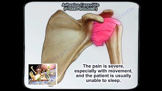 Adhesive Capsulitis Frozen Shoulder  Everything You Need To Know  Dr Nabil Ebraheim [upl. by Merill781]