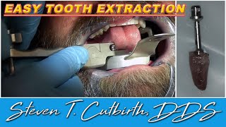 Easy Tooth Extraction  Dental Minute with Steven T Cutbirth DDS [upl. by Annaeirb486]