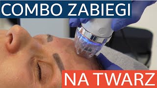 Combo zabiegi na twarz  radiofrekwencja mikroigłowa Secret RF i peeling laserowy Fraxis [upl. by Montagna]