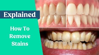 How to remove stains from the teeth [upl. by Adelina235]