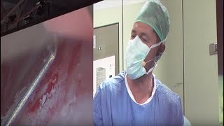 Bladder Instillation with Bruce Kahn MD [upl. by Gnehc]