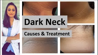 dark neck  causes treatment  Home remedies  Dermatologist Dr Aanchal Panth [upl. by Yenoh675]