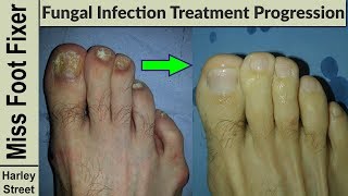 Nail Treatment Progression photo before and after by fungal nail expert [upl. by Moon230]