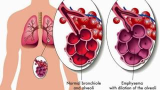 Bronchiolitis Causes Classification Symptoms Diagnosis and Treatment [upl. by Maggio]