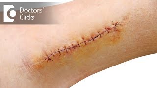 How to get rid of scars due to stitches  Dr Sachith Abraham [upl. by Mulford]