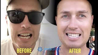 Invisalign Review  Invisalign Before And After [upl. by Nehcterg]