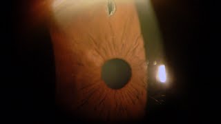 Iridotomia Laser per Glaucoma  Studi Oculistici Abbondanza [upl. by Aerdno]