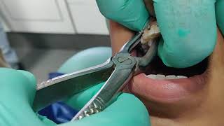 Painless and Easiest method for tooth extraction [upl. by Haramat]