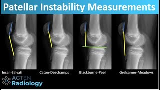 Patient Perspective Congenital hip dysplasia [upl. by Nikolai]