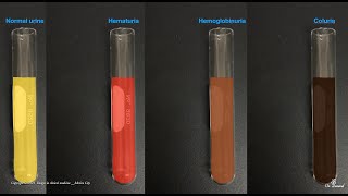 Hematuria Hemoglobinuria Hemosiderinuria and Coluria [upl. by Moulden798]