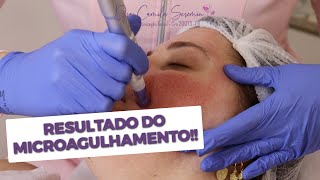 Resultados do Microagulhamento  Antes e Depois  Tratamento para Cicatriz de Acne [upl. by Collin317]