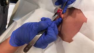 Keloid Removal Ear  Dr Johnson C Lee MD Plastic Surgery [upl. by Giffy]