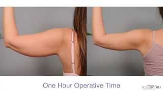 Get Firm Sculpted Arms With Smartlipo™  Dr Sterry Explains [upl. by Osei28]