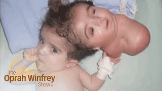 The 2Headed Baby Miracle  The Oprah Winfrey Show  Oprah Winfrey Network [upl. by Nallaf]