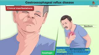 Gastroesophageal reflux disease Animation  GERD  Etiology  Diagnosis  Pathology  Treatment [upl. by Acinahs934]