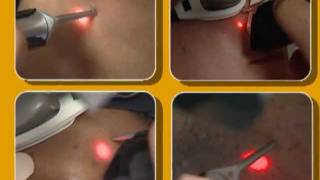 Laser Hair Removal video by Cynosure [upl. by Grove]