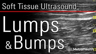 Soft Tissue Ultrasound Lumps amp Bumps [upl. by Rosabel]