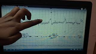 CARDIOTOCOGRAM interpretation in easy way must do for OSPE [upl. by Wilden]