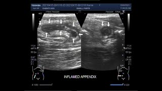 Localization of the inflamed Appendix [upl. by Lennox]