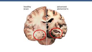 Dementia education I The brain and dementia [upl. by Gninnahc114]