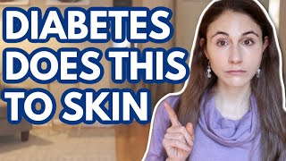 WHAT DIABETES DOES TO YOUR SKIN  DERMATOLOGIST DrDrayzday [upl. by Meldon]