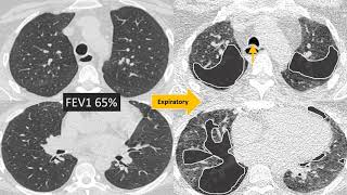 Understanding Bronchiolitis [upl. by Daberath912]