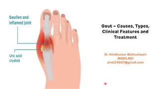 Gout  Types Clinical Features and Treatment  Hyperuricemia  Uric Acid  Biochemistry [upl. by Richers436]