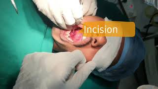 Large Submandibular duct stone Sialolithiasis removal surgery by Dr Jayendiran Subramaniam [upl. by Icul]