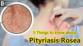 5 Things to know about Pityriasis Rosea  Pityriasis Rosea Rash  Dr Divya SharmaDoctors Circle [upl. by Brendis]