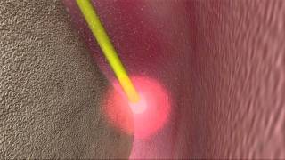 Laser Periodontal Therapy  WPT™ Animation [upl. by Drew299]