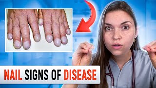 Doctor Explains what your NAILS say about your HEALTH Top 10 Nail Problems [upl. by Ysdnyl]