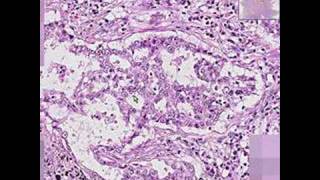 Histopathology Lung Adenocarcinoma [upl. by Nerval]