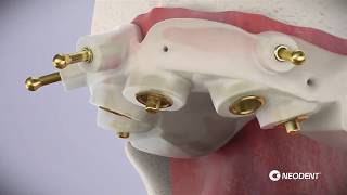 Implantes com Cirurgia Guiada [upl. by Adias]