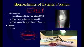 Orthopaedic Implants 2  External Fixation [upl. by Ahsetal]