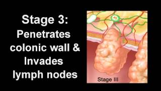 Colon Cancer Diagnosis amp Treatment  Los Angeles Colonoscopy [upl. by Leugim177]