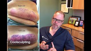 Sculpsure vs Coolsculpting  Which One is Better [upl. by Rekrap]