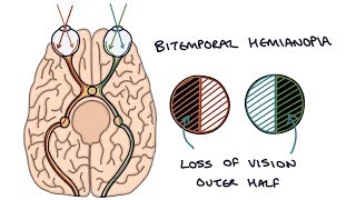 Understanding Bitemporal Hemianopia [upl. by Erodeht]