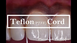 Teflon PTFE cord Placement technique [upl. by Yeltnerb]