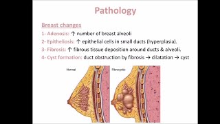 Fibroadenosis [upl. by Nataniel]