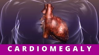 CARDIOMEGALY what causes cardiomegaly [upl. by Gotcher849]