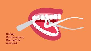 What to Know for Your Tooth Extraction  Colgate® [upl. by Moule]