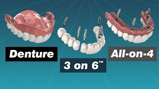 Alternative to Dentures Comparing Dentures Overdentures Allon4 and 3 on 6™ [upl. by Eema]