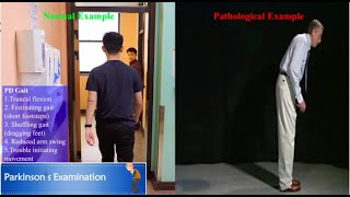 Parkinsons Disease Gait amp Posture [upl. by Hnahc283]